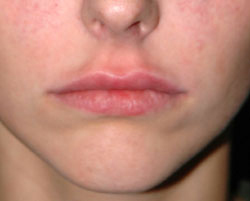 Lip Augmentation - Patient 1 - After